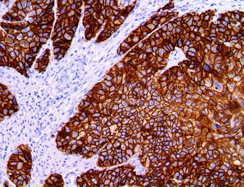 IHC of Desmoglein-3 on an FFPE Squamous Cell Carcinoma Tissue